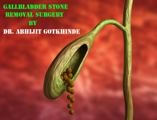 Gallbladder Stone Removal Surgery In Pune By Dr. Abhijit Gotkhinde